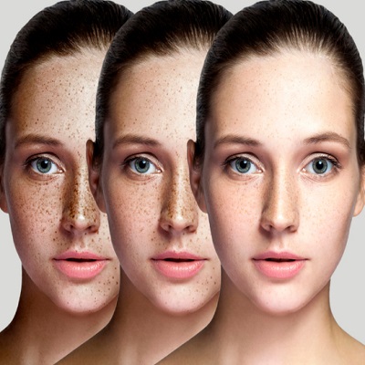skin-pigmentation